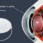 Intraocular Lens Iol Market