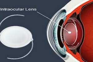 Intraocular Lens Iol Market